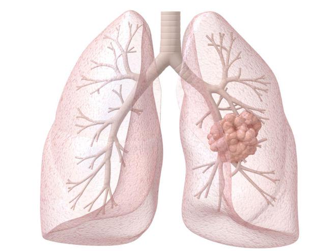 NSCLC 靶向抉择：泰瑞沙 VS 布加替尼，谁更胜一筹
